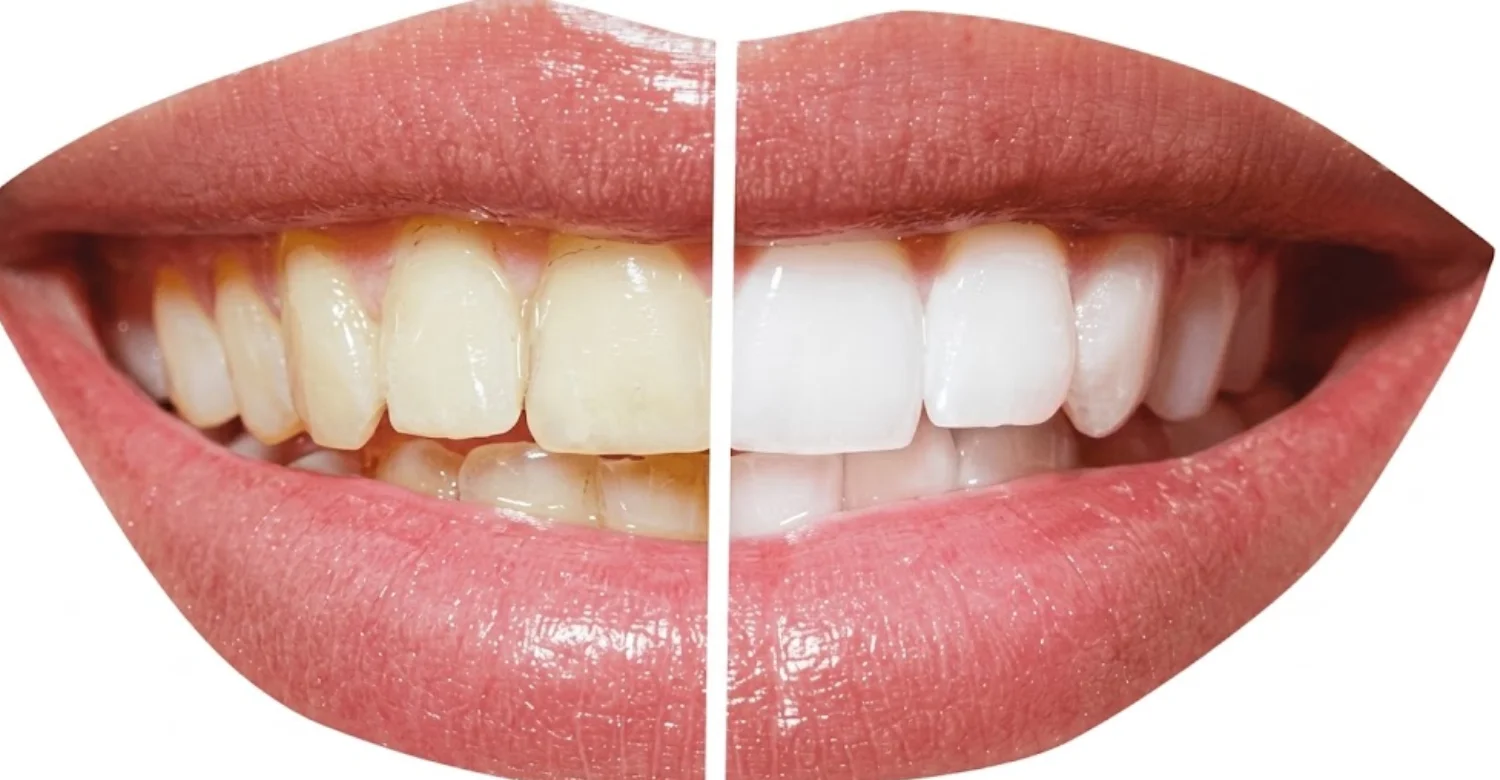 professional teeth whitening vs at home 2